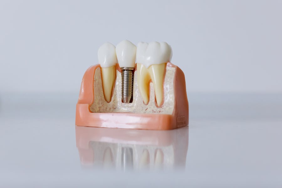 Implant Retained Dentures at Denture Care
