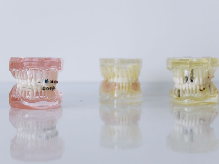 Mouth Guards at Denture Care